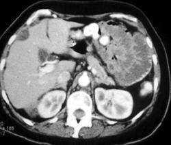 Carcinomatosis - CTisus CT Scan