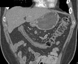 Ischemic Colitis - CTisus CT Scan