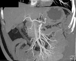 Normal Sma/celiac - CTisus CT Scan