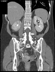 Recurrent Colon Cancer Involves Right Pelvic Sidewall - CTisus CT Scan