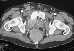 Carcinoid Tumor With Bone Metastases - CTisus CT Scan