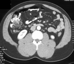 Diverticulitis - CTisus CT Scan