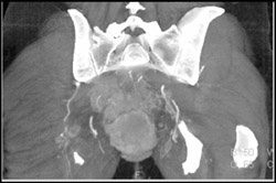 Recurrent Colon Cancer Invades the Sacrum - CTisus CT Scan