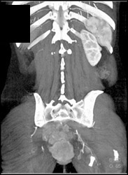 Recurrent Colon Cancer Involves Sacrum - CTisus CT Scan