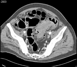 Diverticulitis - CTisus CT Scan