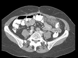 Diverticulitis - CTisus CT Scan