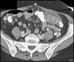 Diverticulitis - CTisus CT Scan