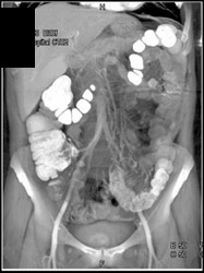 Diverticulitis - CTisus CT Scan