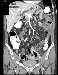 Diverticulitis - CTisus CT Scan