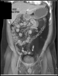 Retroperitoneal Lipoma - CTisus CT Scan