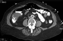 Colon Cancer - CTisus CT Scan