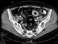 Sigmoid Cancer - CTisus CT Scan