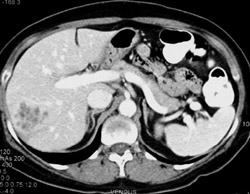 Liver Metastases - CTisus CT Scan