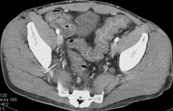 Pseudomembranous Colitis (PMC) - CTisus CT Scan