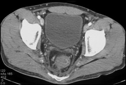 Perirectal Thickening - CTisus CT Scan