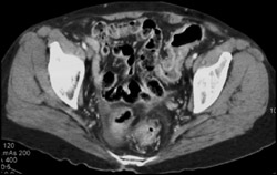 Ulcerative Colitis - CTisus CT Scan