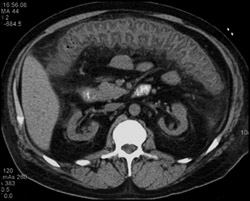 Pseudomembranous Colitis (PMC) - CTisus CT Scan