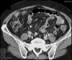 Carcinomatosis - CTisus CT Scan