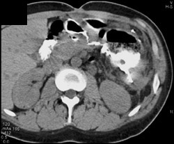 Colon-stomach Fistulae - CTisus CT Scan