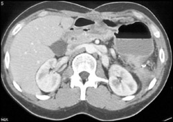 Fistulae From Stomach to Colon - CTisus CT Scan