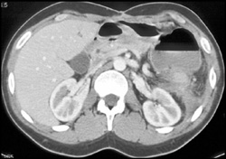 Gastrocolic Fistulae - CTisus CT Scan