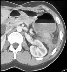 Gastrocolic Fistulae Best Seen With Positive Contrast - CTisus CT Scan