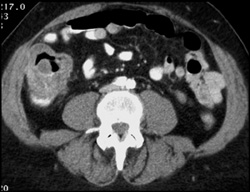 Ulcerating Cecal Cancer - CTisus CT Scan