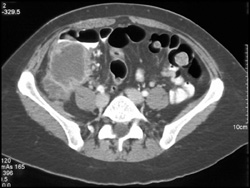 Appendiceal Abscess - CTisus CT Scan