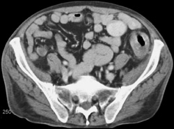 Ischemic Colitis - CTisus CT Scan