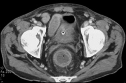 Ischemic Colitis - CTisus CT Scan