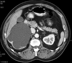 Ureteropelvic Junction (UPJ) Due to Obstructed Ureter By Recurrent Colon Cancer - CTisus CT Scan