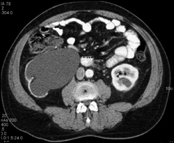 Recurrent Colon Cancer - CTisus CT Scan