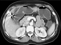 Tumor at Small Bowel-colon Anastomosis - CTisus CT Scan