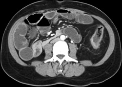 Ulcerative Colitis - CTisus CT Scan