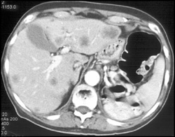 Colon Cancer With Liver Metastases - CTisus CT Scan