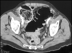 Rectal Cancer - CTisus CT Scan