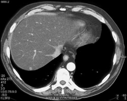 Crohn's Disease - CTisus CT Scan