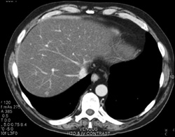 Crohn's Disease and Fatty Liver - CTisus CT Scan