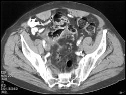 Diverticular Abscess - CTisus CT Scan