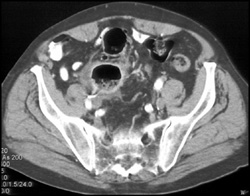 Diverticulitis With Abscess - CTisus CT Scan