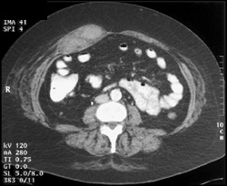 Rectus Hematoma Felt to Be Appendicitis - CTisus CT Scan