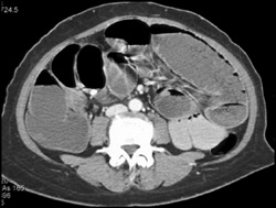 Small Bowel Obstruction (SBO) Due to Cecal Mass - CTisus CT Scan