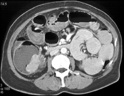 Cecal Cancer Obstructs the Ileum - Colon Case Studies - CTisus CT Scanning