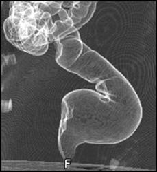 Normal Virtual Colon - CTisus CT Scan