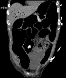 Air in Portal Vein - CTisus CT Scan