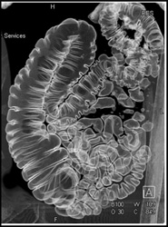 Normal Colon With 2 Different Renderings - CTisus CT Scan