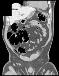 Lipoma in Transverse Colon - CTisus CT Scan