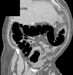 Descending Colon Cancer - CTisus CT Scan