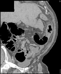 Colon Cancer - CTisus CT Scan