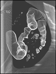 Colon Cancer - CTisus CT Scan